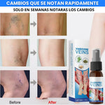 ✨ SPRAY VARICES CRIOTERAPIA ULTRA™ 2x1 | Alivio y Cuidado para las Várices 🦵🛡️