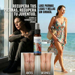 ✨ SPRAY VARICES CRIOTERAPIA ULTRA™ 2x1 | Alivio y Cuidado para las Várices 🦵🛡️